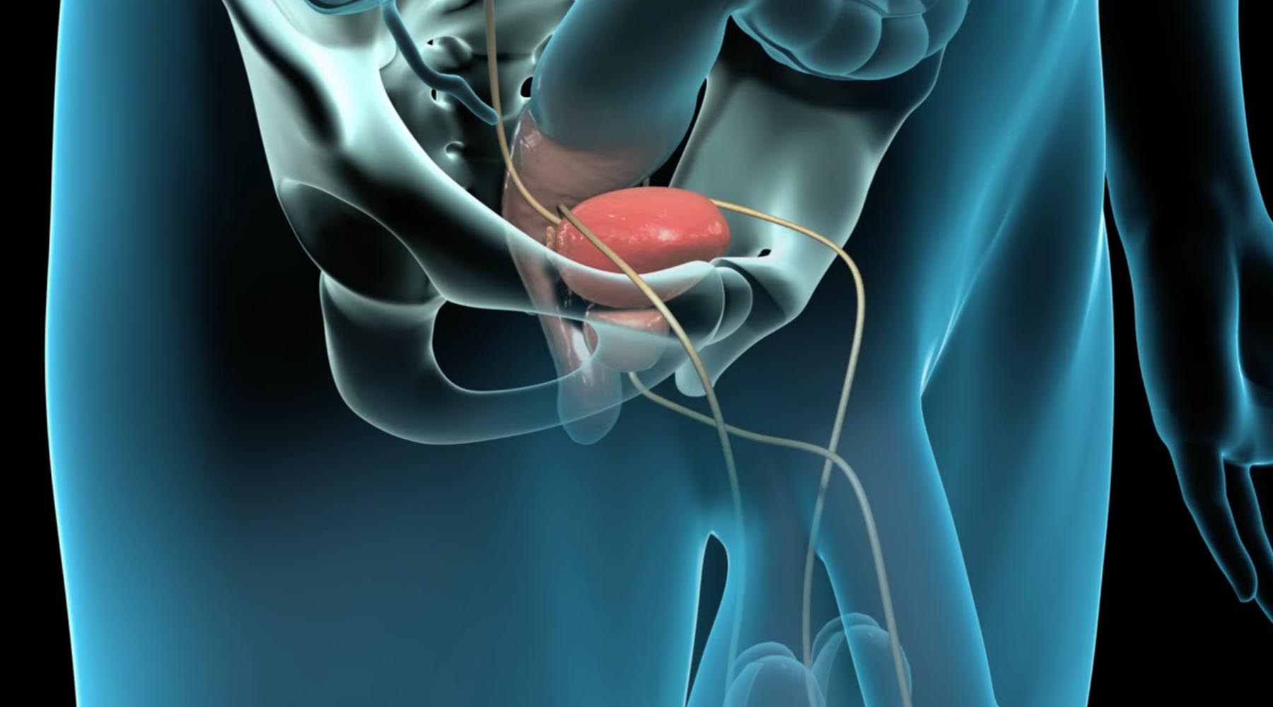 Dr. Jairo Domínguez tratamiento de cáncer de próstata